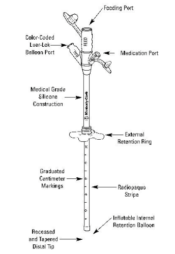 Picture of Mic-Key Tube Gastronomy Feeding Tube, 20 French, 7 to 10 mL, Adult, Internal Retention Balloon, Secur-Lok